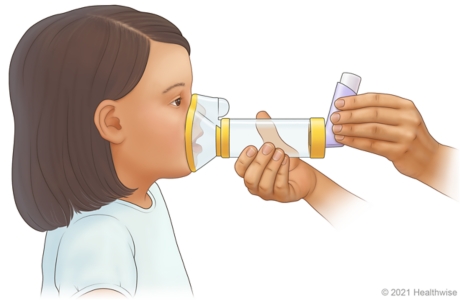 Adult placing mask of spacer over child's mouth and nose. Adult placing mask of spacer over child's mouth and nose.